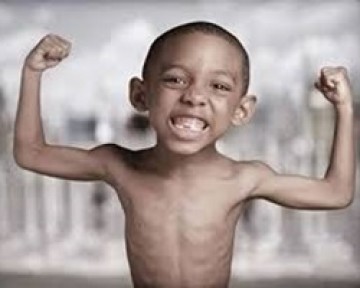 trẻ suy dinh dưỡng